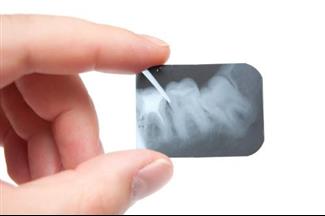 לטפל בשיניים בזמן טיפול בסרטן