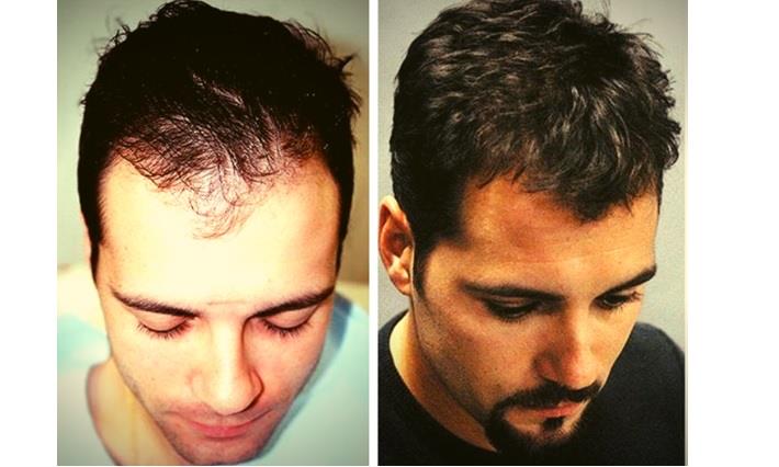 גבר צעיר לפני ואחרי השתלת שיער