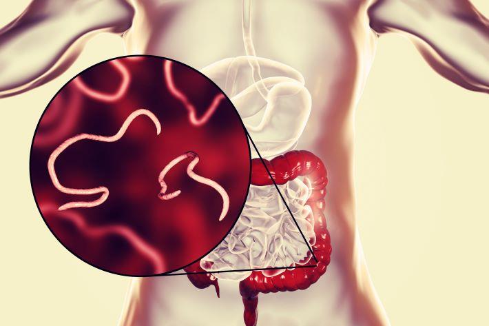 תמונת הדמייה, תולעים במערכת העיכול, מבנדאזול (ורמוקס)