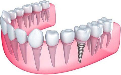 הדמייה של שתל באחת השיניים כחלקת מהליך השתלת שיניים