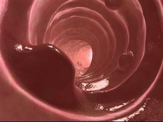 בוצעה השתלת מעי דק הראשונה בישראל