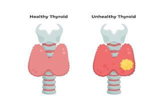 גושים בבלוטת התריס: האם בכל מקרה יידרש ניתוח?
