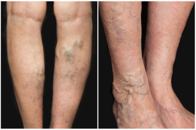 דליות ורידים