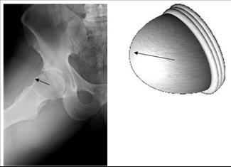 ארתרוסקופיה של מפרק הירך