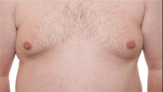 ניתוח הקטנת חזה לגברים: המדריך המלא