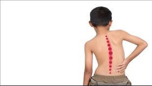 עקמת: מה גורם לה ובאיזה גיל כדאי להתחיל לטפל?