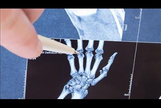 מהם התסמינים שיכולים להעיד על דלקת מפרקים אצל ילדים?