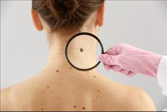 הכירו את העמותה הישראלית לסרטן העור