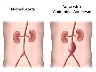 מפרצת אבי העורקים הבטני: מתי יש צורך בטיפול?