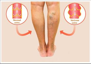 דליות ורידים: הכירו את הטיפולים החדשים