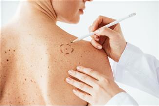 מלנומה גרורתית: מה הטיפולים הקיימים?