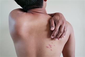 האם שלבקת חוגרת מדבקת?