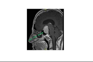 גידולי היפופיזה (בלוטת יותרת המוח): האם תמיד צריך לטפל?