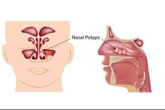 פוליפים באף: המידע שחשוב לדעת