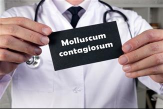מולוסקום: מה חשוב לדעת על מחלת העור המדבקת? מדריך להורים