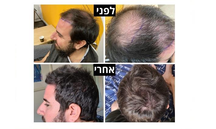 גבר במהלך השתלת שיער ואחריה
