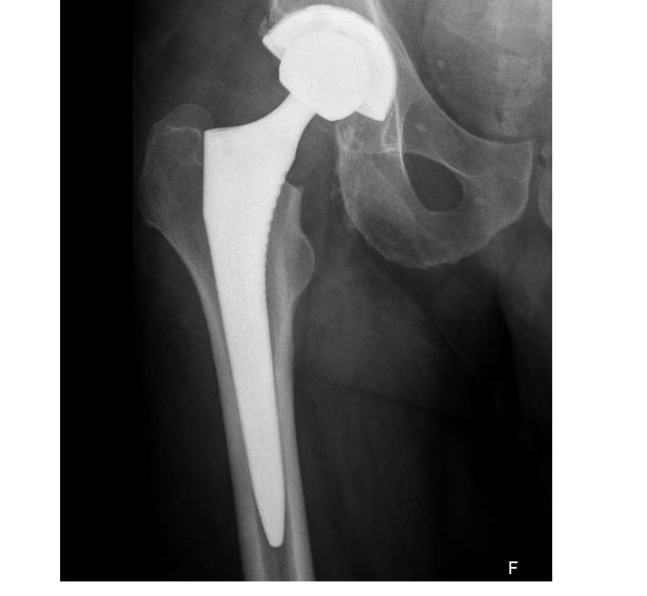 צילום רנטגן , משתל אחרי ניתוח החלפת מפרק ירך