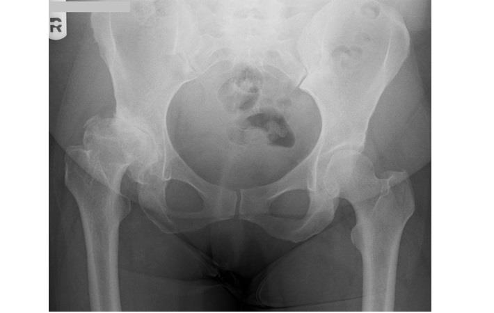 צילום אגן, בירור לפני ניתוח החלפת מפרק ירך