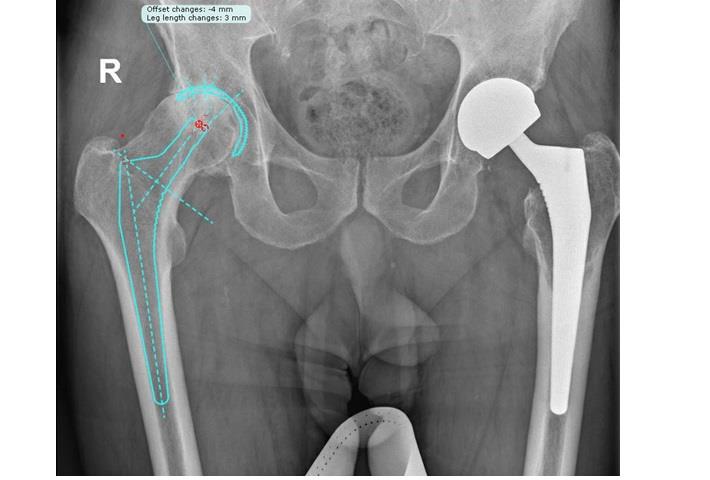 תכנון טרום ניתוחי , החלפת מפרק ירך