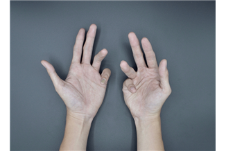 כשהשרירים יוצאים מאיזון: מהי ספסטיות?