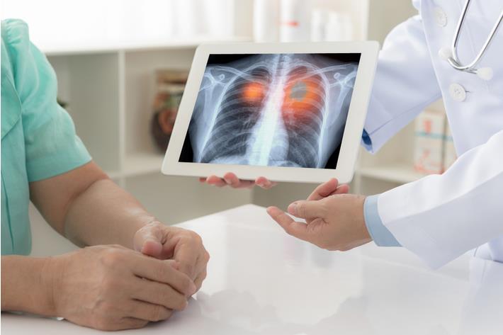 רופא מסביר למטופל על מהלך הטיפול בסרטן ריאה מסוג תאים שאינם קטנים