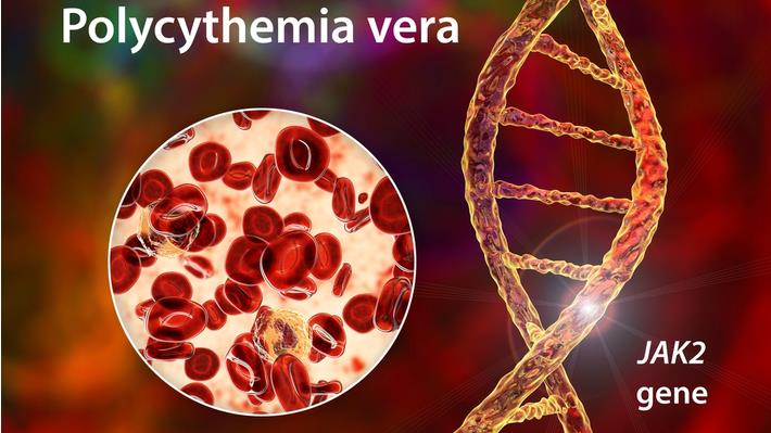 אילוסטרציה של הפגם הגנטי המוביל להתפתחות של פוליציטמיה ורה