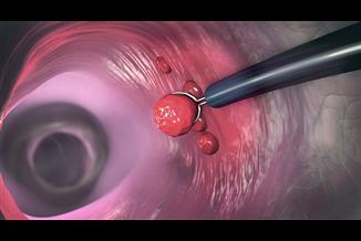 גילו לכם פוליפים? כך תדעו מתי זה מסוכן