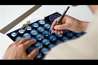 טרשת נפוצה : איך אפשר לשמר את היכולות הקוגניטיביות?