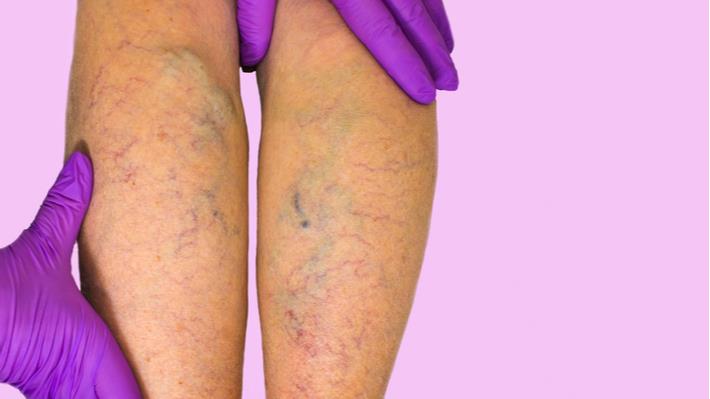 דליות ורידים