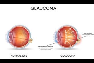 טיפול בלייזר SLT לגלאוקומה: הנה מה שחשוב לדעת