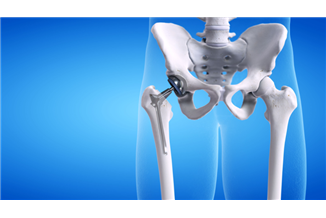 חידושים בניתוח החלפת מפרק ירך