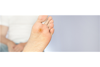 יבלת ויראלית בכף הרגל: מה היא וכיצד ניתן לטפל בה?