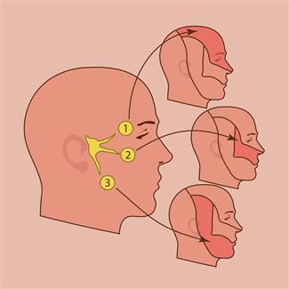פחות תופעות לוואי וסיכונים: טיפול בבוטוקס לתסמונת העצב המשולש