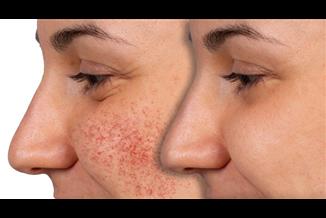 איך להרגיע אלרגיה בפנים: המדריך המלא לטיפול מידי