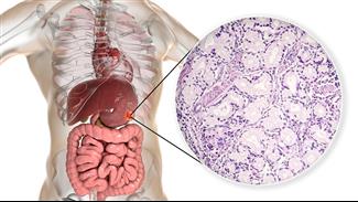 הסרת גידולים במערכת העיכול באמצעות הליך ה-ESD : המדריך המלא
