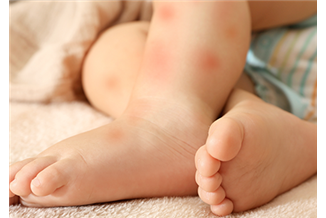 אלרגיה או רגישות למזון? כך תדעו