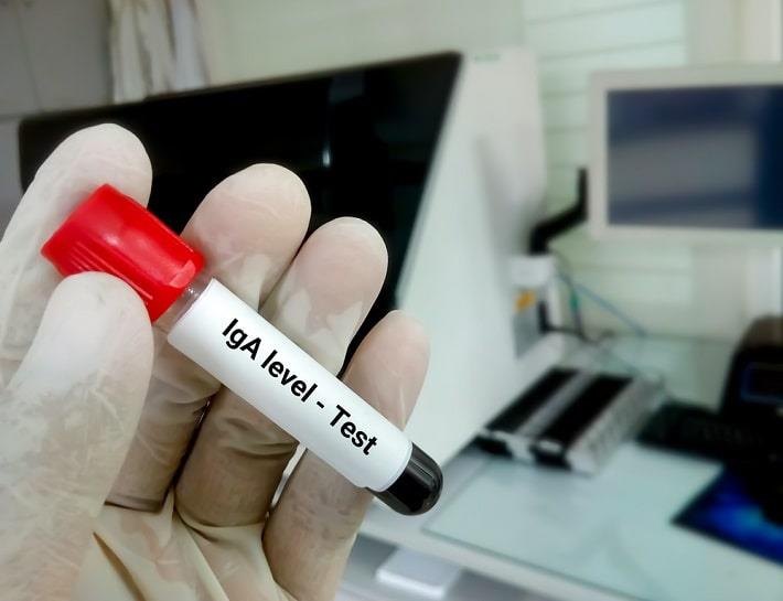 יד אוחזת במבחנת דם של בדיקת נוגדני IgA