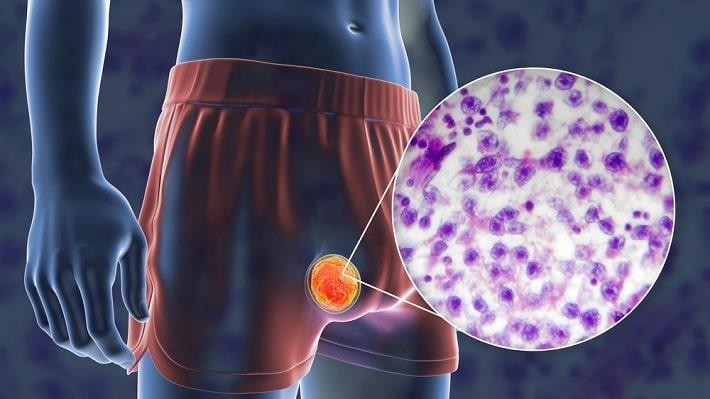 איור תלת מימד רפואי של גבר, הגדלה של צילום מיקרוסקופי של תאים סרטניים באזור איבר המין, סרטן האשכים