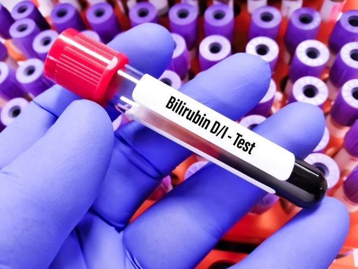 יד מחזיקה במעבדה מבחנה של בדיקת בילירובין ישיר