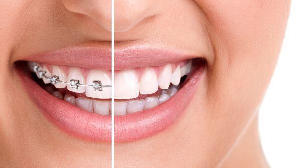 אישה מחייכת כשעל חלק מפיה יש גשר בשיניים